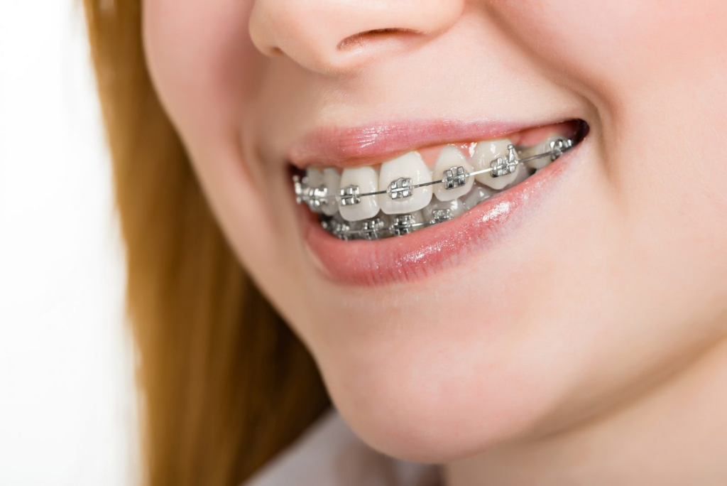 What Are the Different Types of Braces?